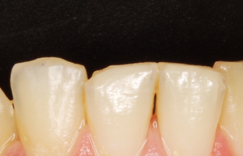 Bild eines abgebrochenen Zahns (2).