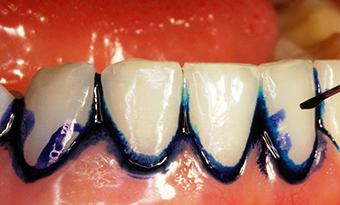 Zähne mit blauem Farbstoff an den Zahnhälsen.