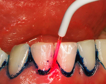 Zähne mit blauem Farbstoff an den Zahnhälsen.