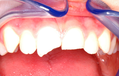 Bild eines abgebrochenen Zahns (4).