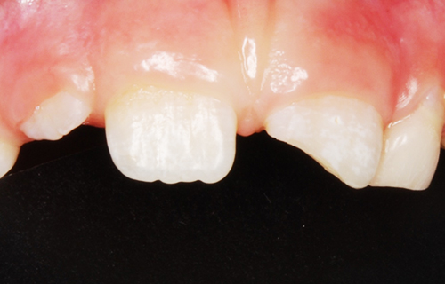 Bild eines abgebrochenen Zahns (3).
