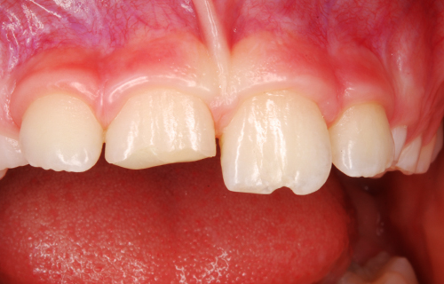 Bild eines abgebrochenen Zahns (1).
